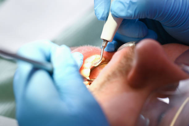 Best Emergency Dentist for Lost Fillings or Crowns in Monrovia, MD